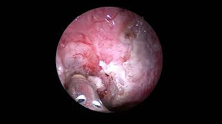 Endoscopic Nasal Meningoencephalocele repair