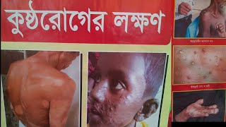 কুষ্ঠ রোগের লক্ষ্মণ এবং চিকিৎসা। Leprosy treatment