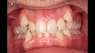 Dental crowding with orthodontic aligners treatment results