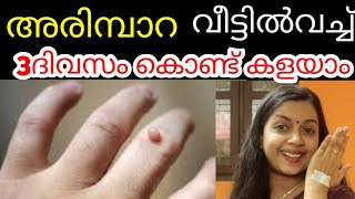 അരിമ്പാറ വീട്ടിൽ വച്ചു3ദിവസം കൊണ്ട് കളയാംThe best methods for removing Warts അരിമ്പാറക്ക് പരിഹാരം118