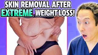 MASSIVE Skin Removal After 300 Lb Weight Loss! Plastic Surgeon Reacts!
