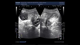 Polycystic ovary syndrome (PCOS), Ultrasound video.