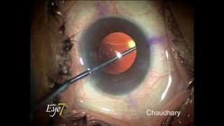 Toric IOL rotation after 15 days with Alcon Acrysof toric lens at Eye7, Delhi, India