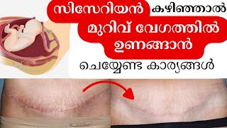 Quick Tips to heal c- Section Scar സിസേറിയൻ കഴിഞ്ഞവർ അറിഞ്ഞിരിക്കേണ്ടത് l How to care after cesarean