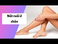 Xem bói nốt ruồi ở chân Trái, Phải Nam, Nữ có ý nghĩa gì? Có giàu không?