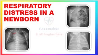 RESPIRATORY DISTRESS SYNDROME, CLINICAL APPROACH TO RDS,HMD, DIFFERENTIAL DIAGNOSIS OF RD IN NEWBORN