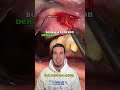 this is how to drain an abscess in a tooth treatment for dental infection