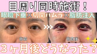 眼瞼下垂・切開ハムラ・脂肪注入の同時施術！気になる傷跡は？