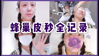 【真实】蜂巢皮秒Picosure全記錄！皮膚真的有變好嗎？||Treatment of Picosure with Discovery Pico