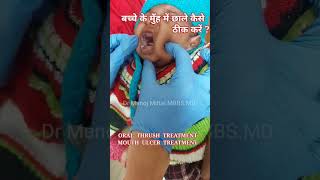 बच्चे के मुँह में छाले कैसे ठीक करें ? | ORAL THRUSH TREATMENT  | MOUTH ULCER TREATMENT