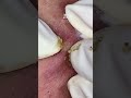 big cystic acne blackheads extraction blackheads u0026 milia whiteheads removal pimple popping shorts