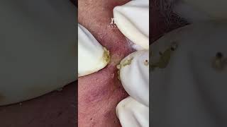 Big Cystic Acne Blackheads Extraction Blackheads \u0026 Milia, Whiteheads Removal Pimple Popping #shorts