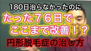 福岡　円形脱毛症の改善方法　１８０日間治らなかった円形脱毛症がたった７６日でここまで改善！？【女性薄毛改善への道のりVOL 96】