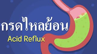 รู้ไหม? ทำไมคุณถึงมีอาการแสบร้อนกลางอก- กรดไหลย้อน Acid Reflux || GERD อาการและการรักษา