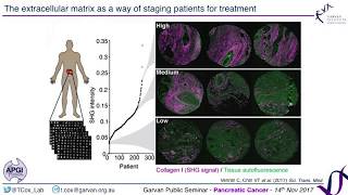 Targeting pancreatic cancer cells - new insights from Dr Thomas Cox