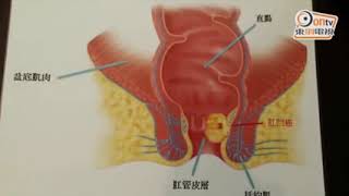 肛門癌病徵似痔瘡　專家籲男性打HPV針預防