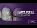 Facetas Diretas com Resinas Compostas e Pigmentos | Leonardo Muniz