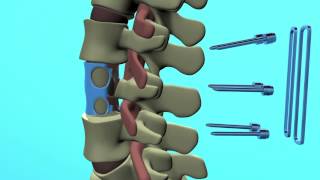 Spinal Animation: Vertebral Body Replacement Surgery- Ivan Moe