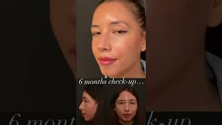 Female Rhinoplasty Surgery  Before and After: 6 Months Later | Dr. Alev Camcıoğlu