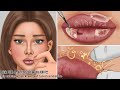 ASMR sebaceous mass explosion! Lip Blackhead Extrusion | Taking care of dead skin cells on your lips