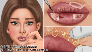 ASMR 피지 덩어리 폭발! 입술 블랙헤드 압출하기 | 입술 각질 관리하기 | lip sebum & blackhead extrusion animation
