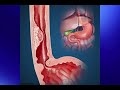 new treatment method for early esophageal cancer mbm and esd