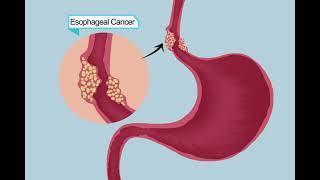 New Treatment Method for Early Esophageal Cancer: MBM and ESD