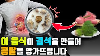 이 음식을 자주 드시면 콩팥에 돌을 만들어서 콩팥을 망가뜨립니다 (신장결석의 종류와 예방법 그리고 예방하는 영양제까지)