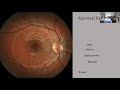 Sight + Sound Bites: Understanding Diabetic Retinopathy