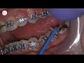 Orthodontic Rubber bands placement by Dr. Amr Asker