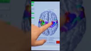 What is Non Invasive Brain Computer Interface? || Which technology is used in Non Invasive BCI?