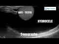 हाइड्रोसील की पूरी जानकारी हिंदी में सब कुछ hydrocele