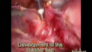 Laparoscopic Hysterectomy with Large Cervical Myomas