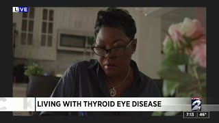 Living With Thyroid Eye Disease