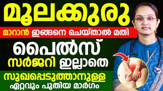 സർജറി ഒന്നും ഇല്ലാതെ തന്നെ മൂലക്കുരു മാറ്റിയെടുക്കാൻ ഇത് മാത്രം മതി