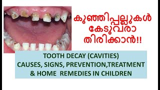 TOOTH DECAY IN CHILDREN -CAUSES, SIGNS, PREVENTION, HOME REMEDIES \u0026 TREATMENT