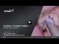 Cartiform® Trochlear Implant