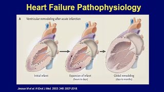 Heart Failure: What it Means and the Many Effective Treatments Now Available