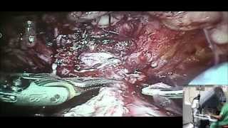 Baxter using Bang for FloSeal Demo for Hemostasis during Prostate Surgery_2 min.mp4