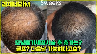 리제네라M 모낭줄기세포시술 후 휴가는? 골프? 다음날 가능하다고요?