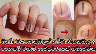 හැමෝටම කලින් ඔබේ ශරීරයේ ලෙඩ ගැන කියන නියපොතු | What your nails say about your health | Awata