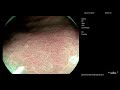 h. pylori diagnosis with magnifying endoscopy