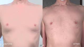 Male Chest Contouring | Gynecomastia | Dr. David Stoker