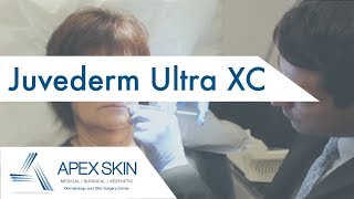 Juvederm Ultra XC FAQ