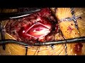 microsurgical resection of a conus medullaris arteriovenous malformation avm