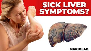 Shocking Symptoms of Liver Damage Visible on Your Skin and Legs