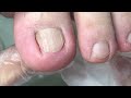 toenails are like blades embedded in the flesh 【drzhang】