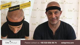 Full Cover Hair Transplant With 7000 Grafts