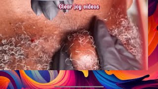 Big Cystic Acne Blackheads Extraction Blackheads \u0026 Milia, Whiteheads Removal Pimple Popping