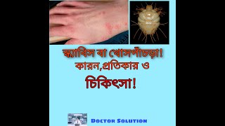 Scabies,Sign Symptoms,Diagnosis and  Treatment||| চুলকানি,বা খোসপাঁচড়ার চিকিৎসা।